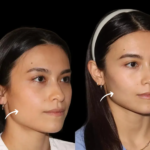 Top 5 Reasons to Visit the Best Sculptra Dermatologist in Dubai