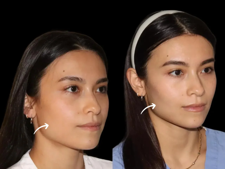 Top 5 Reasons to Visit the Best Sculptra Dermatologist in Dubai