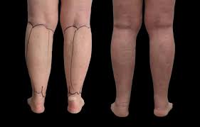 liposuction in dubai