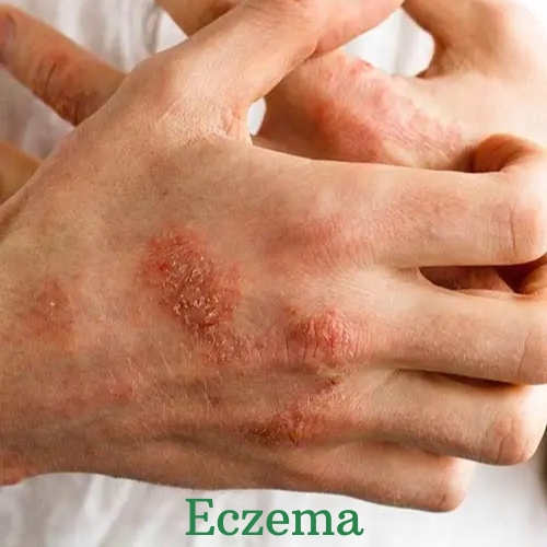 is eczema contagious