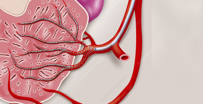 Prostate Artery Embolization vs. Traditional Surgery