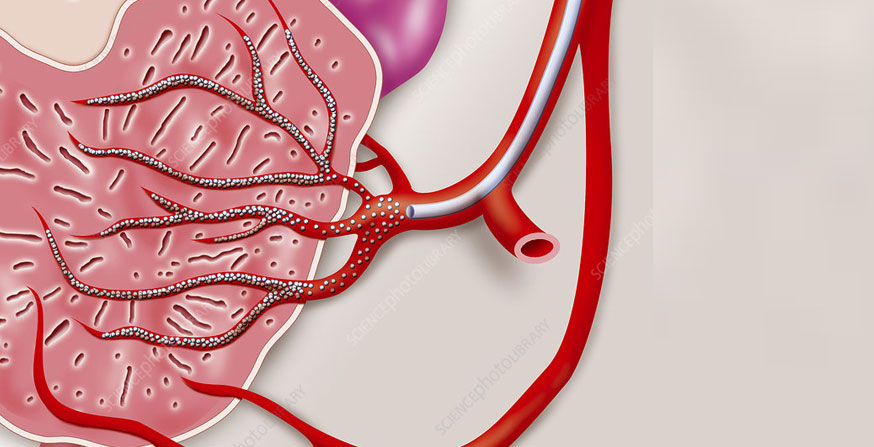 Prostate Artery Embolization