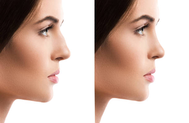 Rhinoplasty in Abu Dhabi