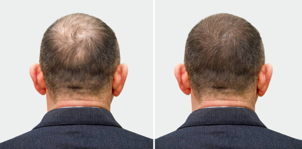 Hair Transplant in Riyadh