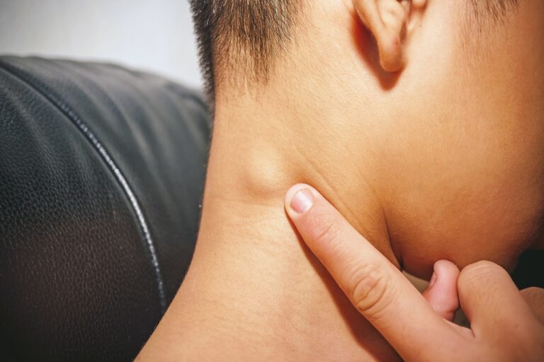 What is a Lipoma? Understanding the Basics and Symptoms to Watch For What is a Lipoma? Understanding the Basics and Symptoms to Watch For