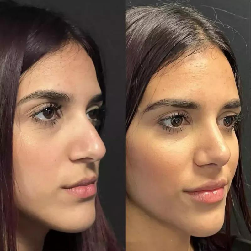 Best Doctors in Dubai for Rhinoplasty: Expert Care