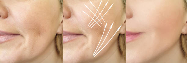 Advanced Laser Hair Reduction Treatment