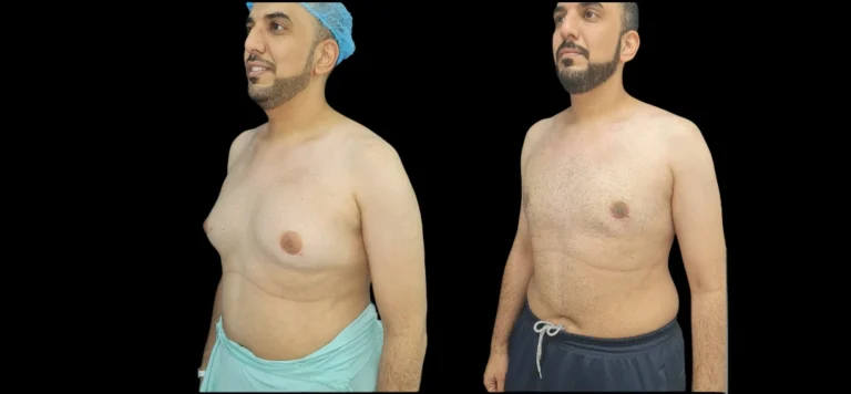 Gynecomastia Surgery in dubai: Achieving a Masculine Silhouette Gynecomastia Surgery in dubai: Achieving a Masculine Silhouette