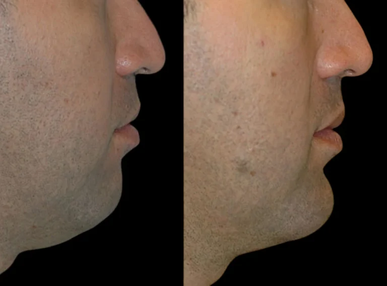 What to Expect from Chin Fillers Injections in Dubai: Your Questions Answered