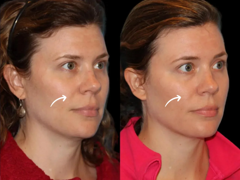 The Safety of Sculptra: What the Best Doctors in Dubai Say