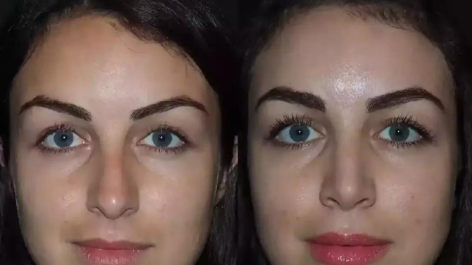 Best Rhinoplasty Doctors Transform Looks in Dubai