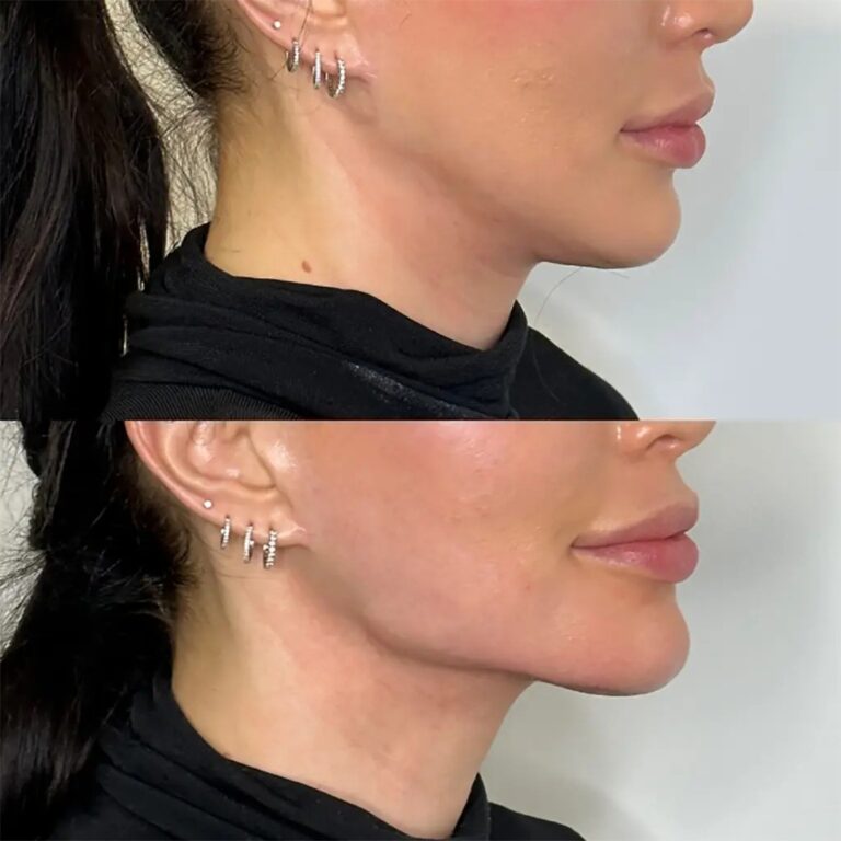 Jawline Fillers Injections in Dubai: Timing Your Treatments for Best Results