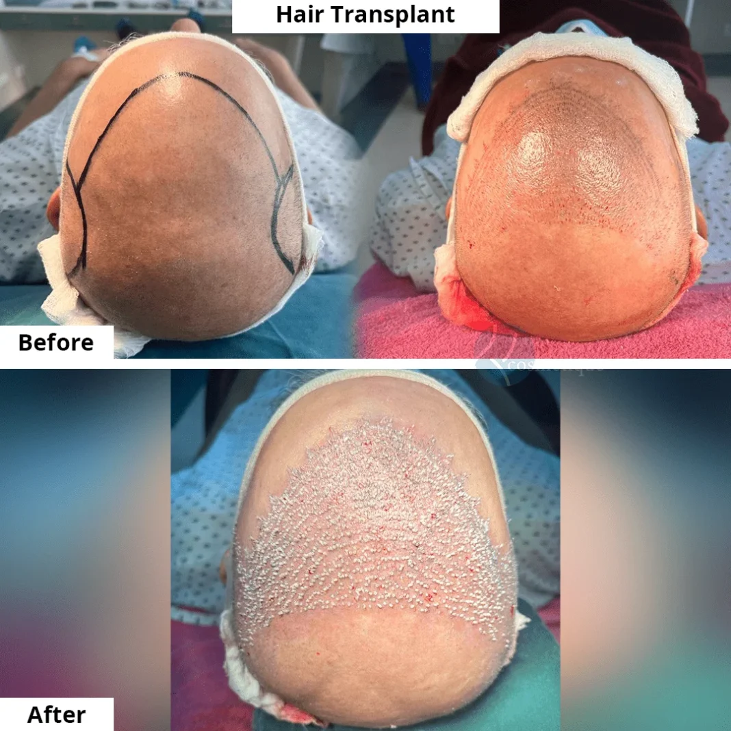 best hair transplant in pakistan