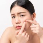 Your Ultimate Guide to Getting Rid of Pimples