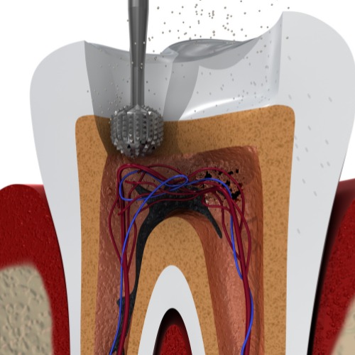 root canal treatement