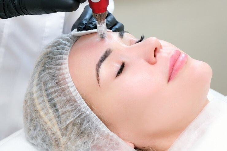 Microneedling in Houston