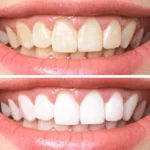 Teeth whitening services in Flagstaff, AZ