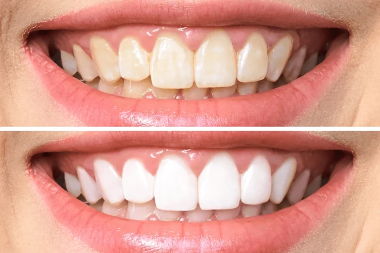 How to Maintain Your Bright Smile After Whitening