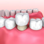 Dental Crowns in Tempe