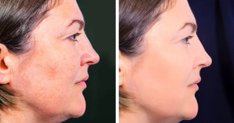 Profhilo for Sensitive Skin: Best Aesthetic Clinics in dubai