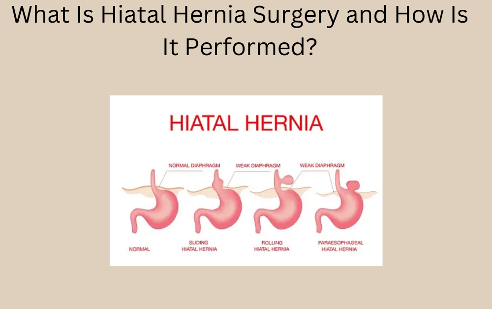 Hiatal Hernia surgery in Dubai