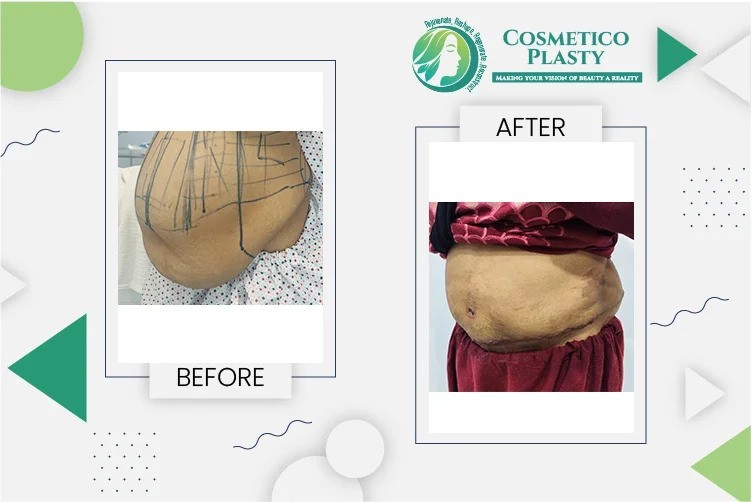 Tummy Tuck in Lahore