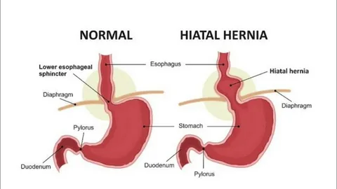 Hiatal Hernia surgery in Dubai