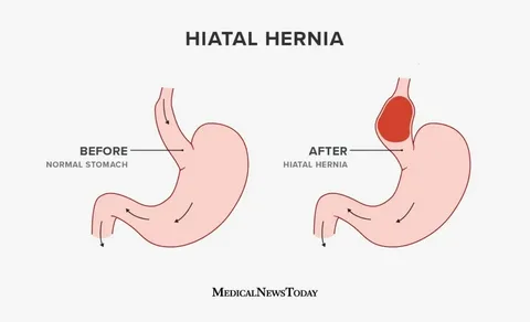 Hiatal Hernia surgery in Dubai