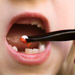 Smile Charlotte: Your Guide for Tooth Extractions in NC